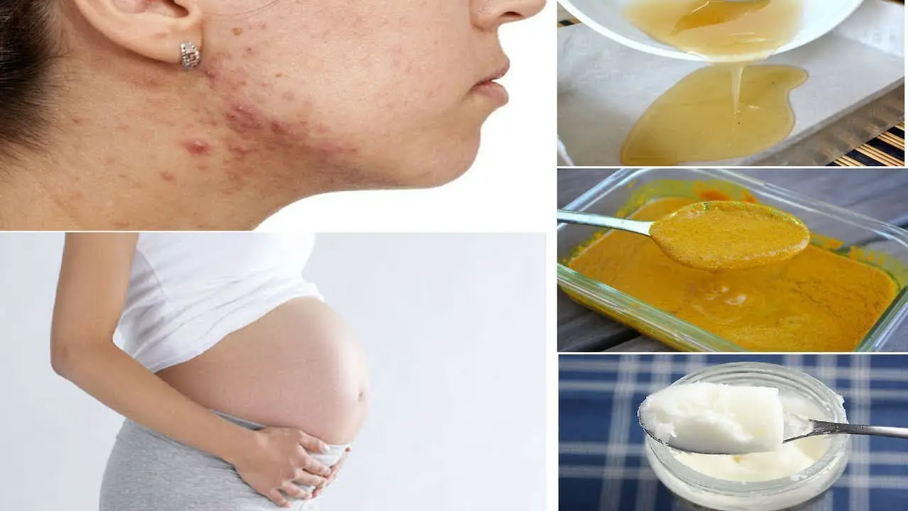 Natural Acne Treatment During Pregnancy
