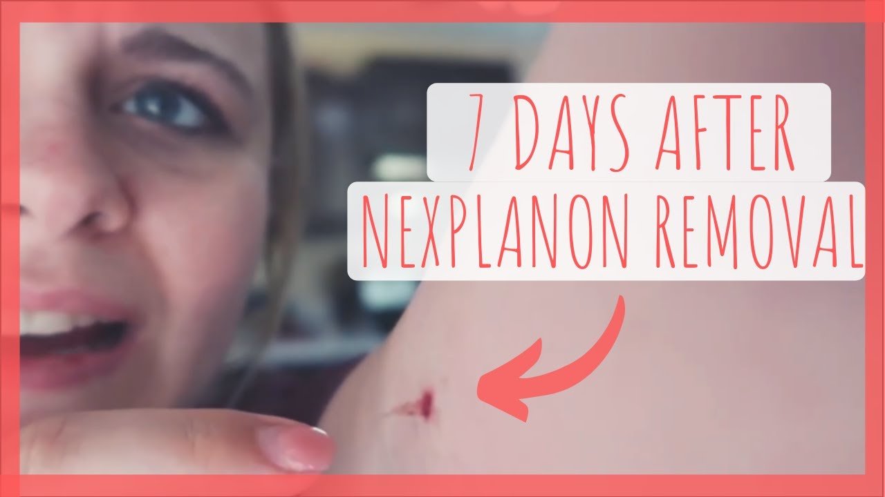 Periods After Nexplanon Removal
