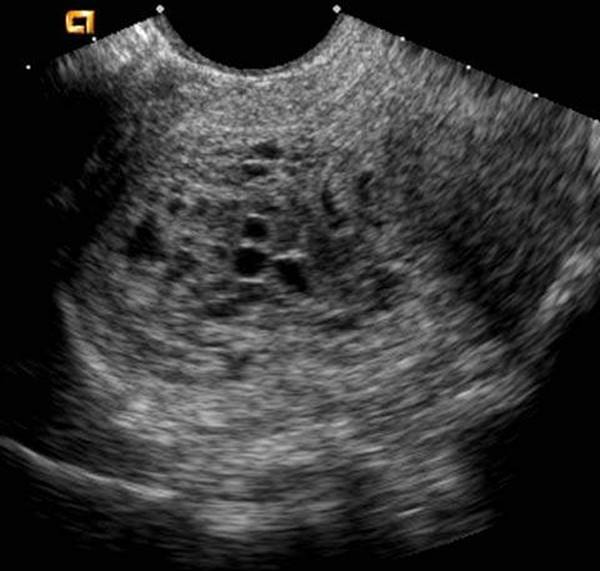 PG NEET OBG MCQs 44  Abortion/Ectopic Pregnancy/GTN  15