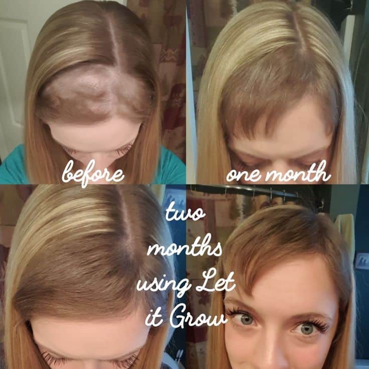 Pin on hair loss before and after