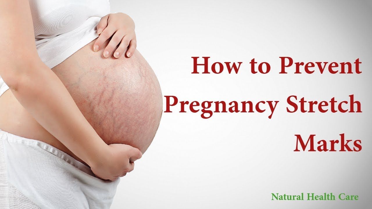 Pin on How to Prevent Pregnancy Stretch Marks I I Natural ...