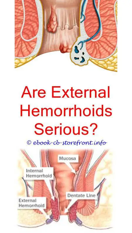 Pin on What Causes Hemorrhoids During Pregnancy
