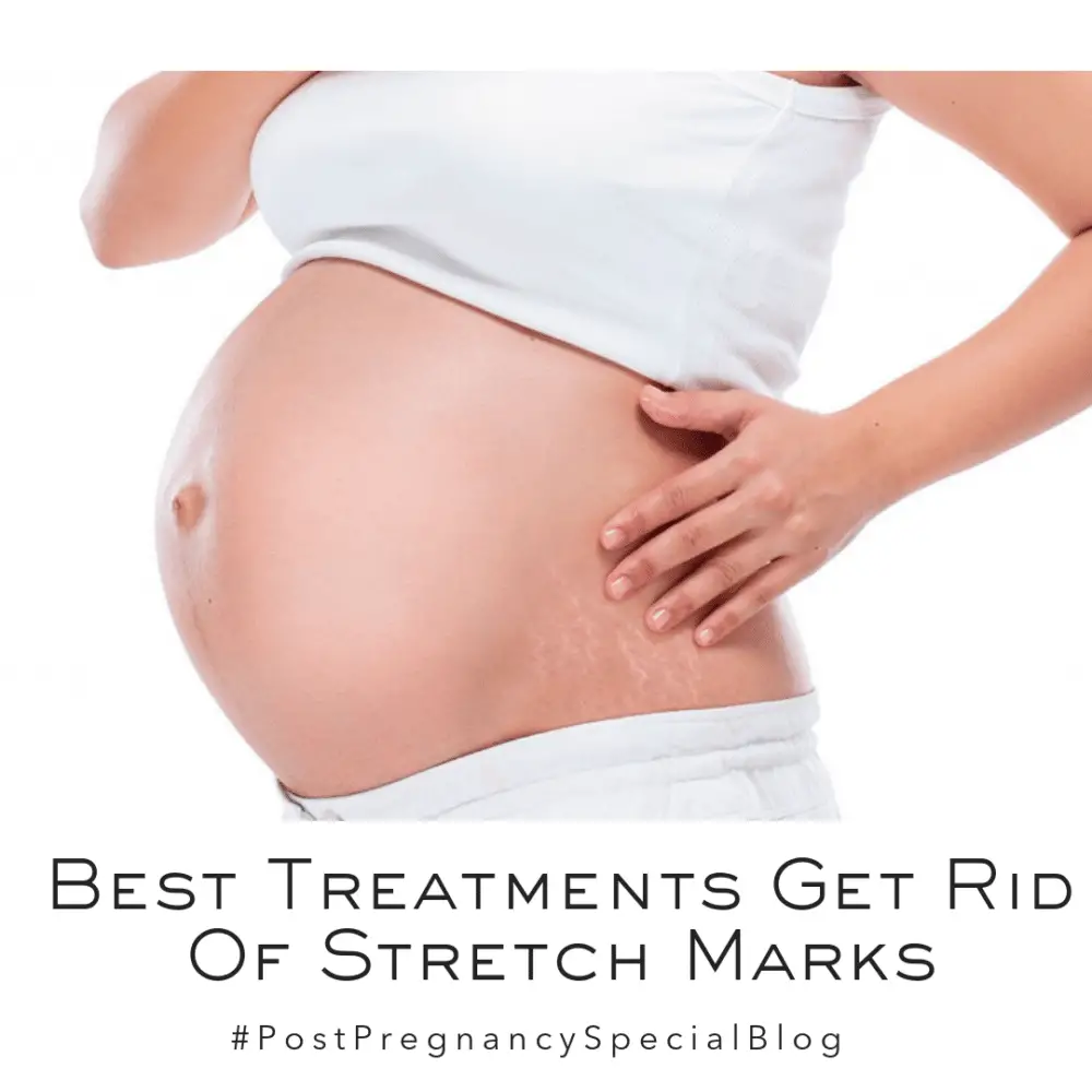 Post Pregnancy Special: Tips And Treatments For Stretch Marks