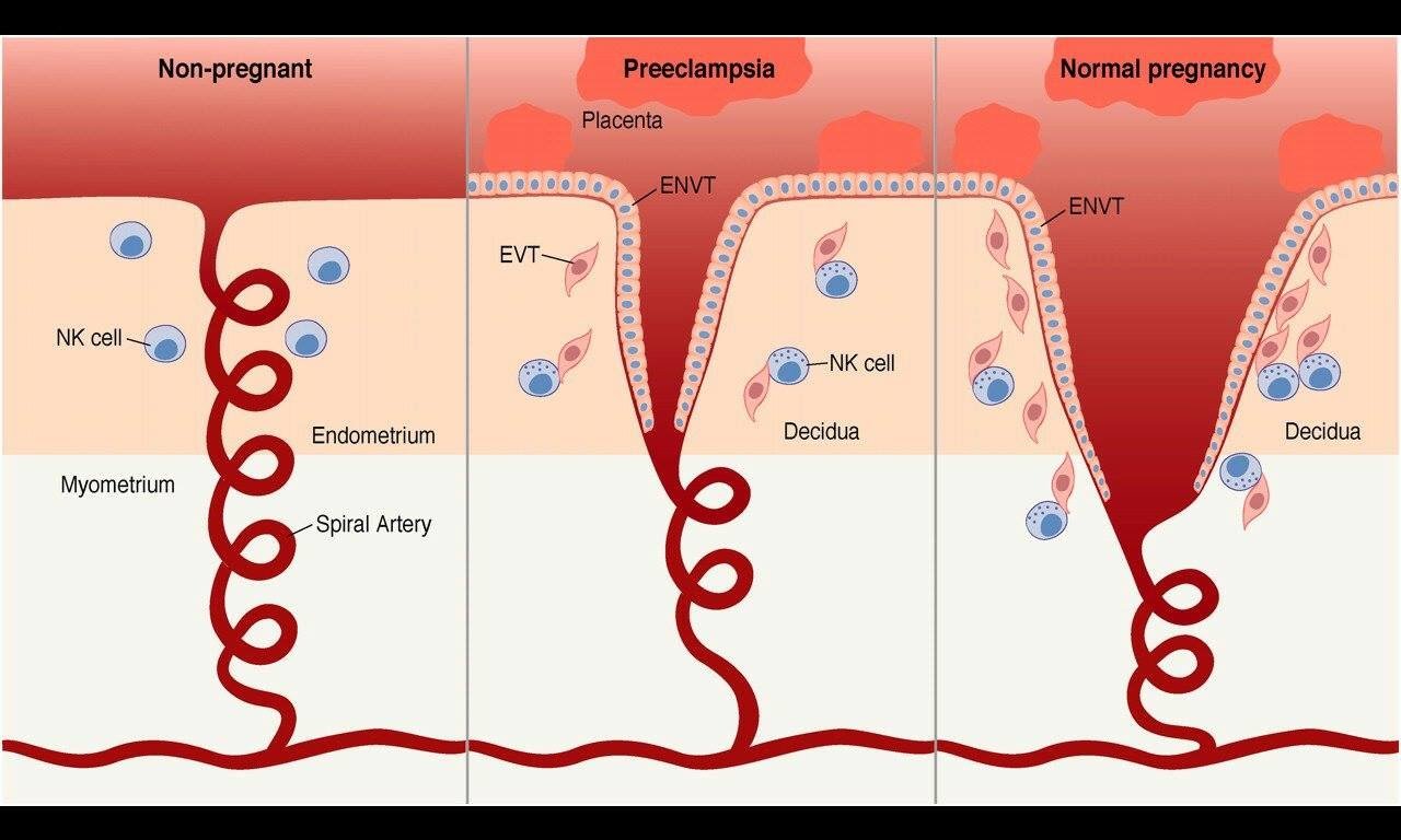 Preeclampsia and Eclampsia â Core EM
