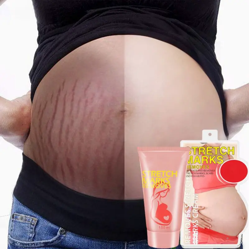 Remove Pregnancy Scars Acne Cream Stretch Marks Treatment Maternity ...