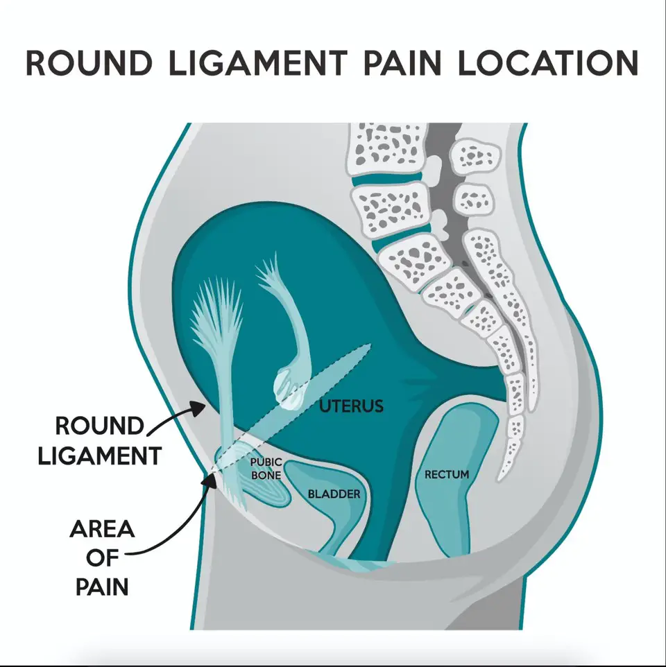 Round Ligament Pain In Pregnancy