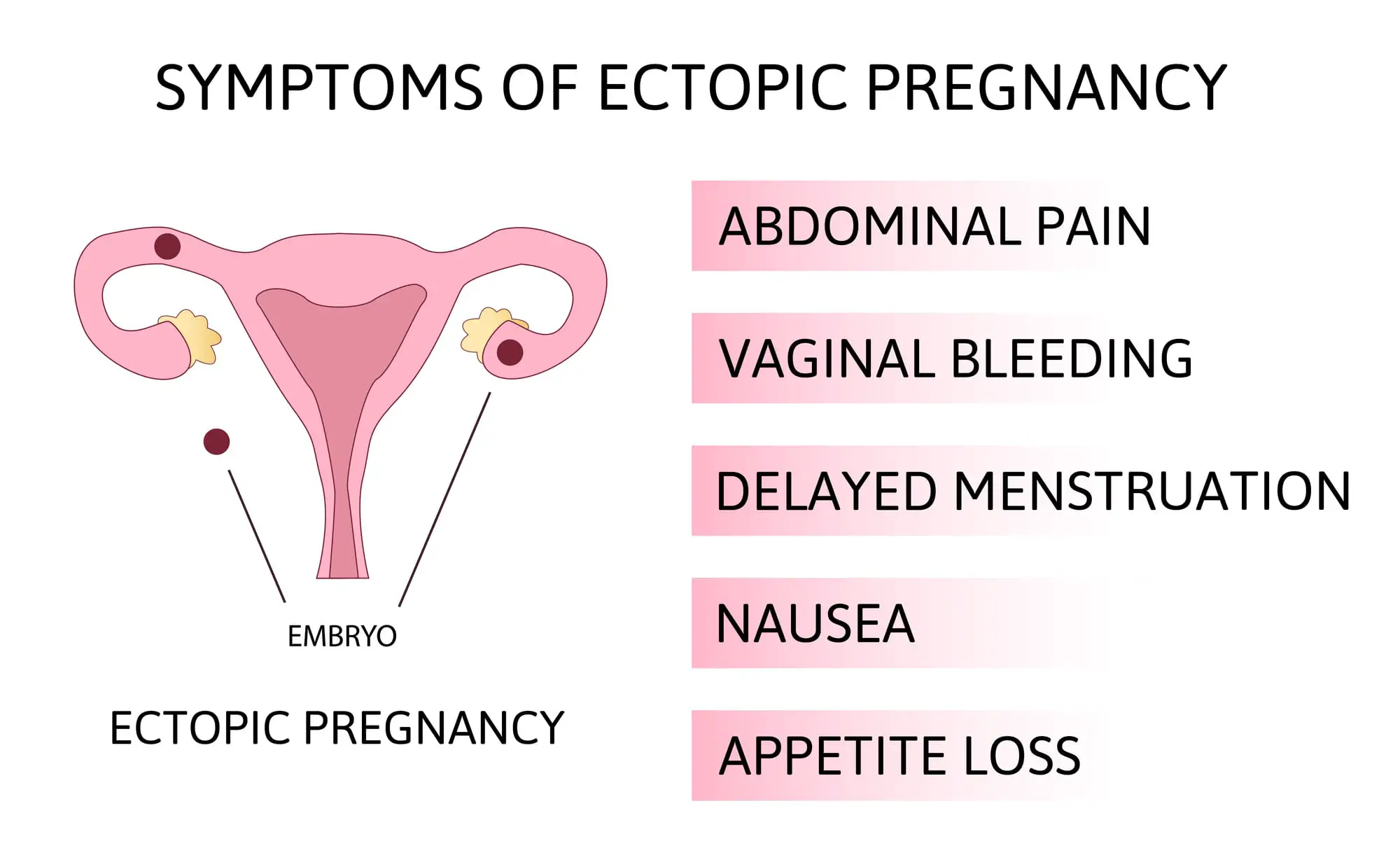 Signs of an Ectopic Pregnancy