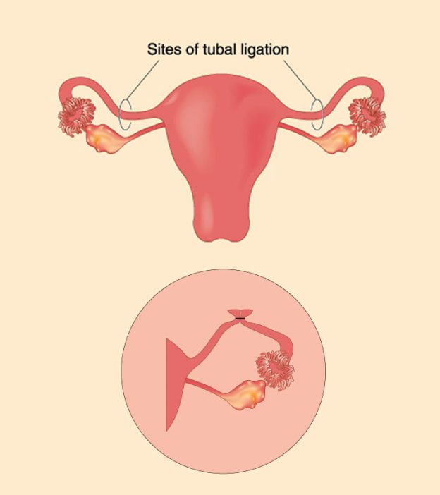 Signs Of Pregnancy After Tubal