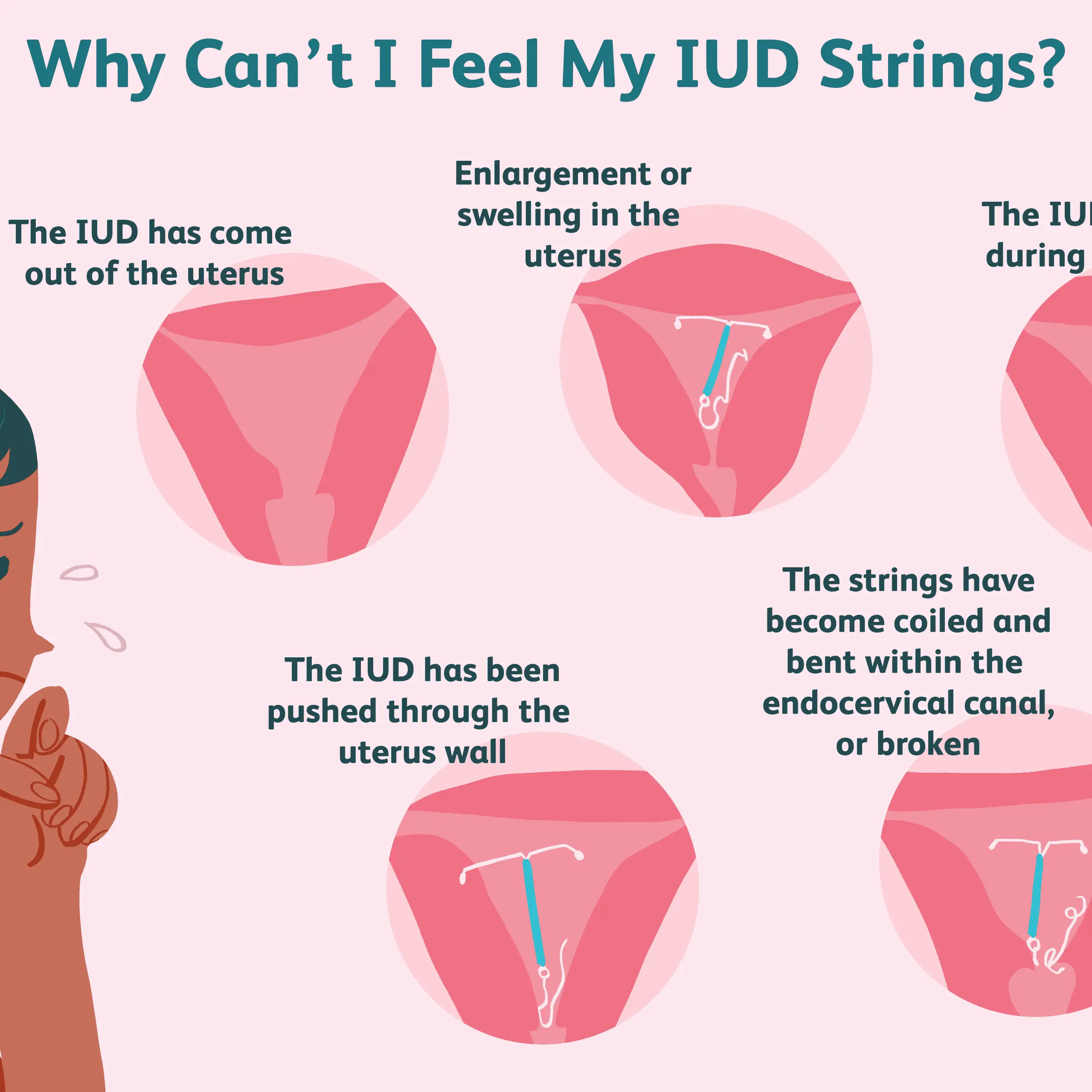 Signs Of Pregnancy On Iud