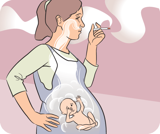 Smoking and pregnancy: in pictures