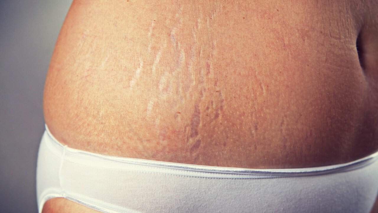 Stretch Marks After Pregnancy  How to Get Rid of Them ...