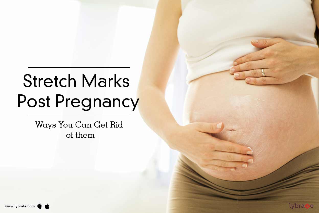 Stretch Marks Post Pregnancy