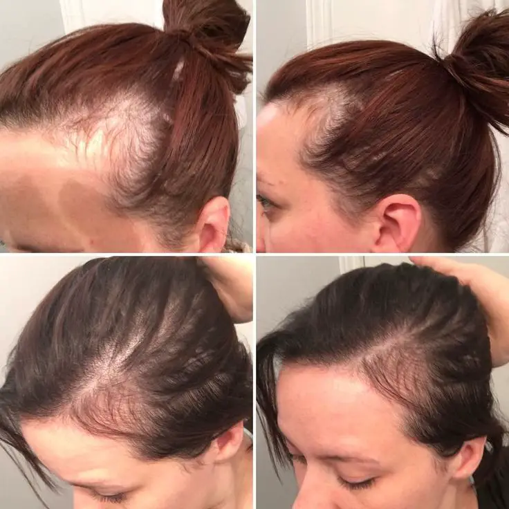 Suffering from postpartum hair loss after baby? Monat can help!