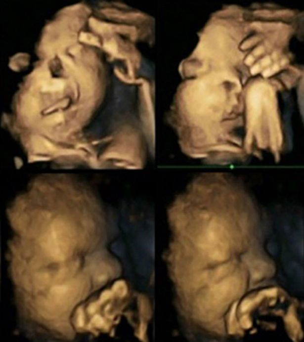 Suffering in the womb: Dramatic pictures show how unborn babies of ...