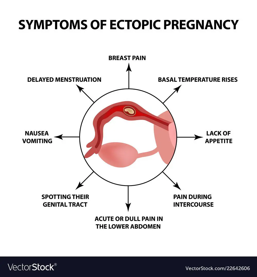 Symptoms of ectopic pregnancy infographics Vector Image
