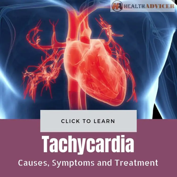 Tachycardia : Causes, Picture, Symptoms And Treatment