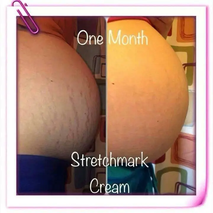 The stretch mark cream from itworks is amazing! You can even use it ...