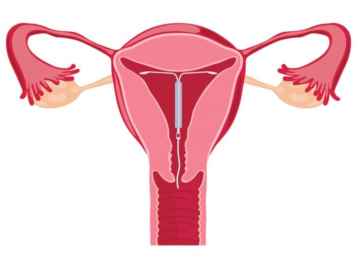 Things You Should Know About IUD Pregnancy