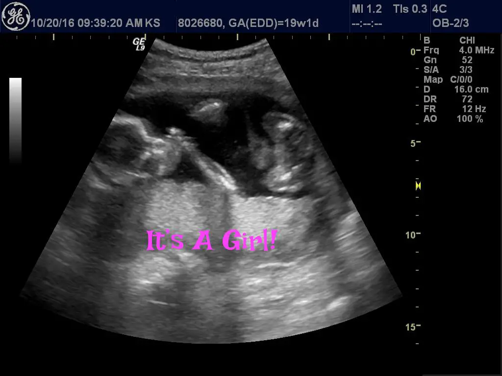 Ultrasound/Gender Reveal