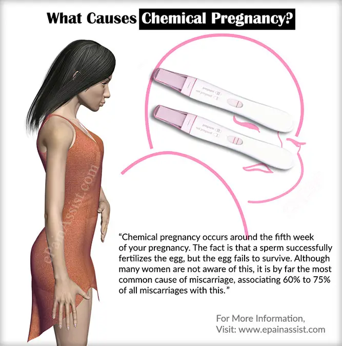 What Causes Chemical Pregnancy &  Does it Require Treatment?