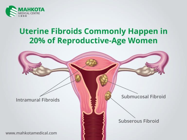 Women Uterine Fibroid: Diagnosis and Screening